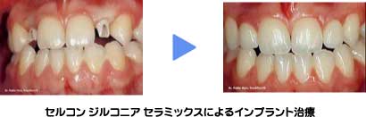 セルコンジルコニアセラミックスによるインプラント治療