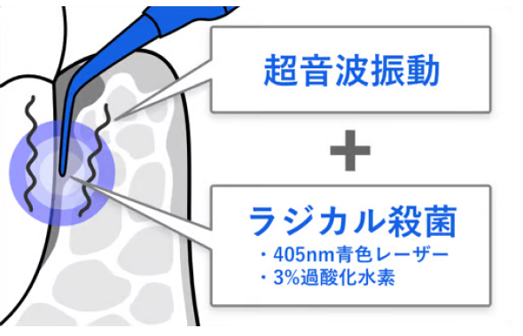 ブルーラジカル