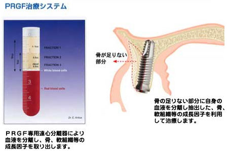 再生歯科医医療(PRGF)